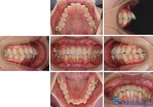 【モニター】口が閉じにくい 抜歯矯正で口元を引っ込めるの治療前