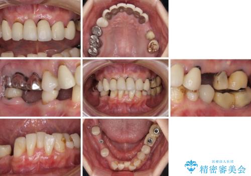 放置したインプラントとインビザライン 全顎リカバリー治療の治療前