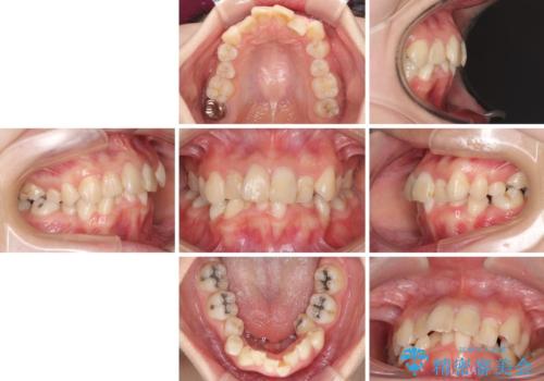デコボコと深い咬み合わせ ワイヤー装置での抜歯矯正の治療前