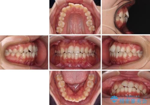 【モニター】短期間で終わりたい ワイヤー装置での非抜歯矯正の治療前