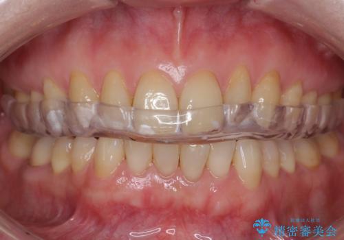 夜間の歯ぎしりを防ぐためのナイトガードの症例 治療後