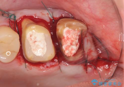 奥歯から臭いがする　銀歯下の虫歯再発の治療中