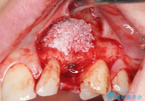 骨造成を伴う 前歯部インプラント治療の治療中