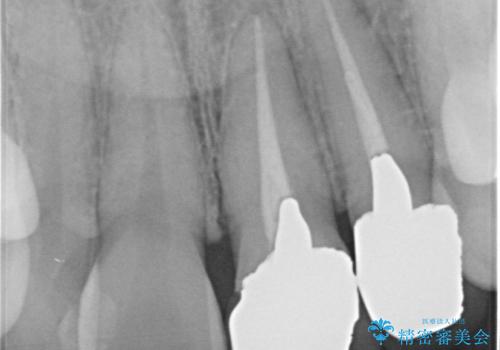 前歯の歯茎の黒ずみと被せ物の形と色が気になる【オールセラミッククラウン】の治療前