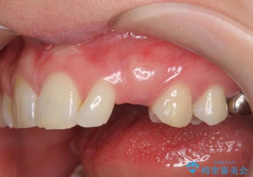 骨造成を伴う 前歯部インプラント治療の症例 治療前