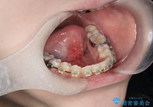 滑舌を改善! 舌小帯の形成術の治療後