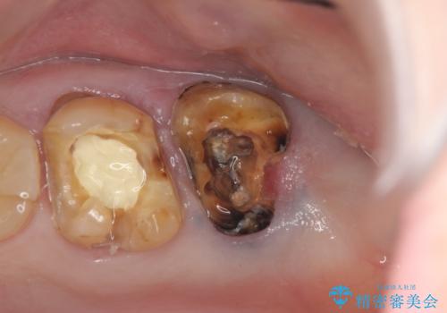 奥歯から臭いがする　銀歯下の虫歯再発の治療前