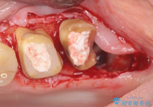 奥歯から臭いがする 銀歯下の虫歯再発の治療中