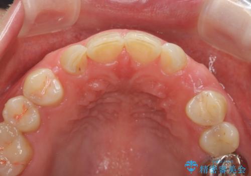 骨造成を伴う 前歯部インプラント治療の治療前