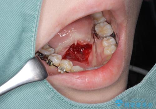 滑舌を改善! 舌小帯の形成術の治療中