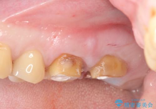 奥歯から臭いがする 銀歯下の虫歯再発の治療中