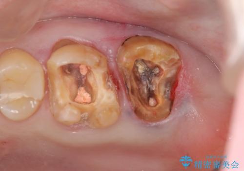 奥歯から臭いがする　銀歯下の虫歯再発の治療前