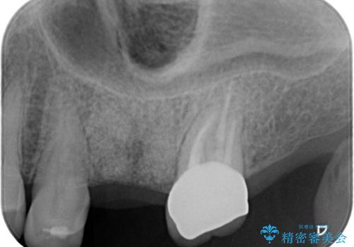 【歯牙破折】インプラントによる咬合回復の治療前
