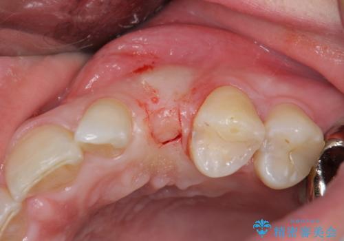 骨造成を伴う 前歯部インプラント治療の治療中