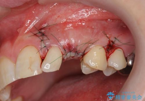 骨造成を伴う 前歯部インプラント治療の治療中