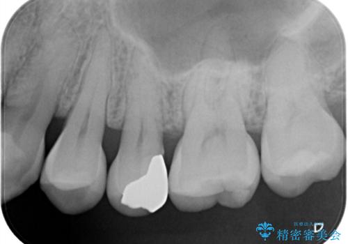 矯正後セラミックインレーにしたいの治療前