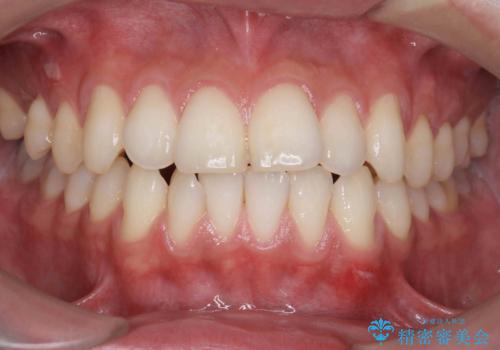 突出した前歯を改善! マウスピース治療の症例 治療前