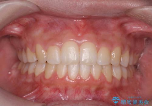 歯を抜かない矯正　出っ歯を抜かずに大きく下げることは可能です。の症例 治療後