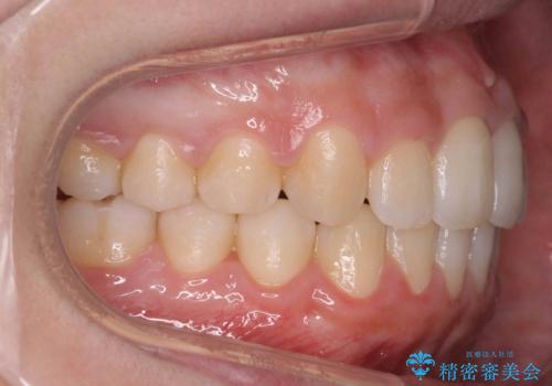 歯を抜かない矯正 出っ歯を抜かずに大きく下げることは可能です。の治療後