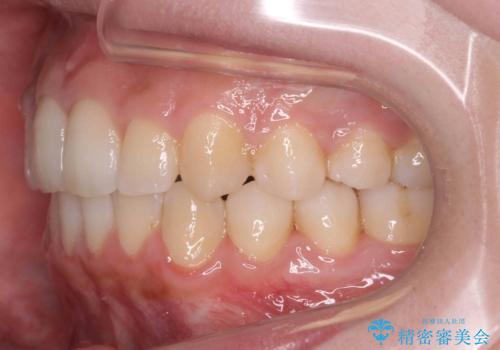 歯を抜かない矯正　出っ歯を抜かずに大きく下げることは可能です。の治療後