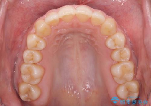 歯を抜かない矯正 出っ歯を抜かずに大きく下げることは可能です。の治療後