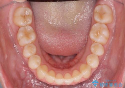 歯を抜かない矯正 出っ歯を抜かずに大きく下げることは可能です。の治療後