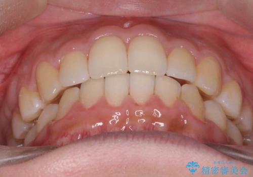 歯を抜かない矯正　出っ歯を抜かずに大きく下げることは可能です。の治療後