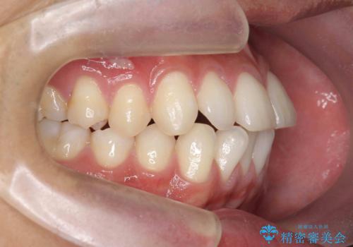 突出した前歯を改善! マウスピース治療の治療前