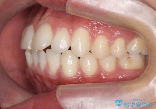 突出した前歯を改善! マウスピース治療の治療前