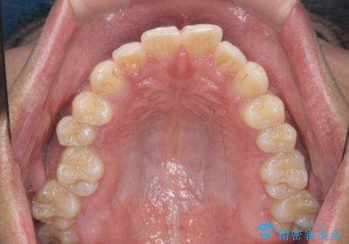 突出した前歯を改善! マウスピース治療の治療前