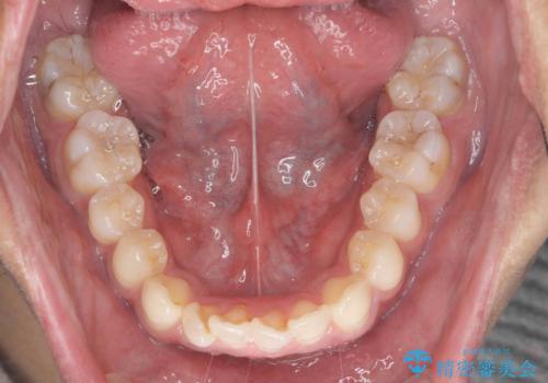 突出した前歯を改善! マウスピース治療の治療前