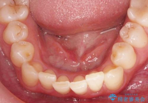 [ インビザラインライトプラン ]  費用を抑えた下顎前歯の小矯正の症例 治療前