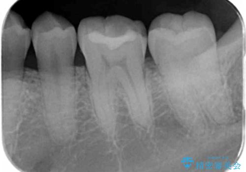 奥歯が欠けた セラミックインレーでの治療の治療前