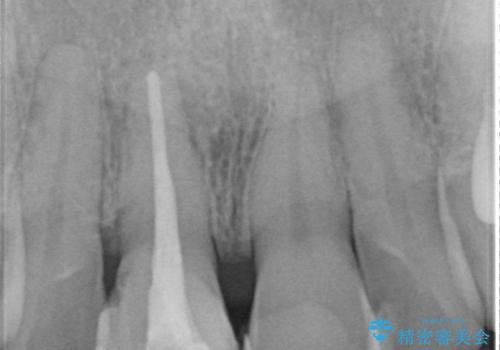 前歯の変色を改善!セラミック治療の治療前