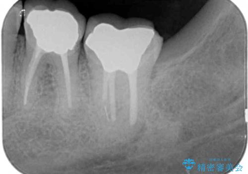 海外赴任前に治したい 割れてしまった奥歯のオールセラミッククラウンの治療前