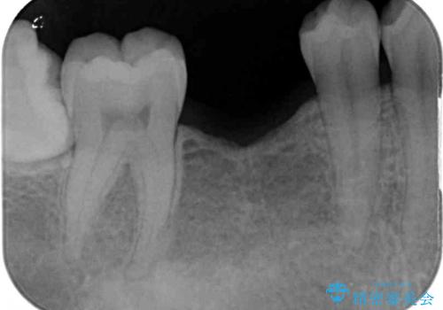 空いている時間を利用して通院 奥歯のインプラント治療の治療前