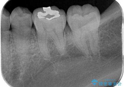 銀の詰め物を白くしたい。の治療前