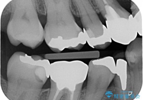 メタルインレーやりかえの治療前
