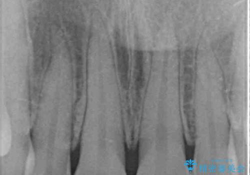 変色した前歯をオールセラミッククラウンにの治療前