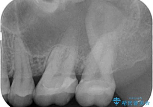 奥歯がズキズキと痛む 奥歯の虫歯治療の治療前