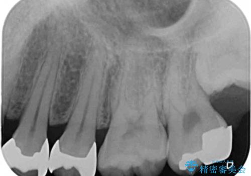 銀歯を目立たなくしたい セラミックインレーでの治療の治療前