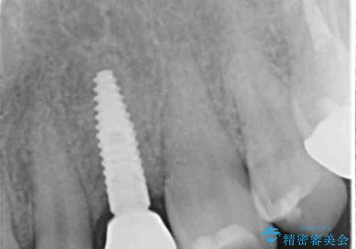 骨造成を伴う 前歯部インプラント治療の治療後