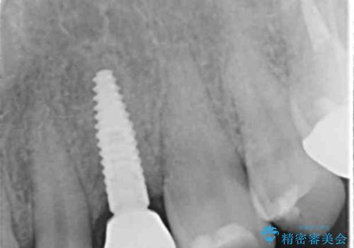 骨造成を伴う 前歯部インプラント治療