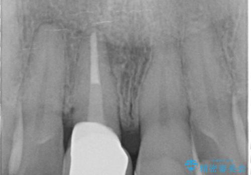 前歯の変色を改善!セラミック治療