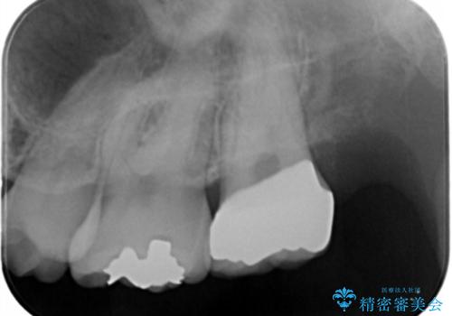 黒くなった奥歯をジルコニアクラウンにの治療後