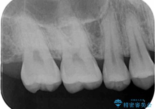 銀歯を白くしたい セラミックインレーでの治療の治療後