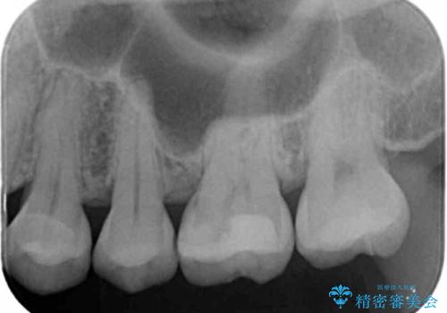 歯と歯の間の虫歯 セラミックインレーでの治療の治療前