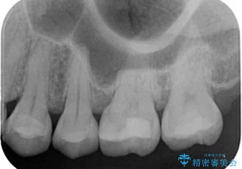 歯と歯の間の虫歯 セラミックインレーでの治療の治療後