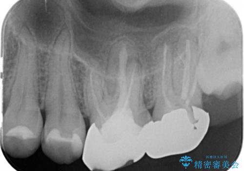 奥歯から臭いがする 銀歯下の虫歯再発の治療前