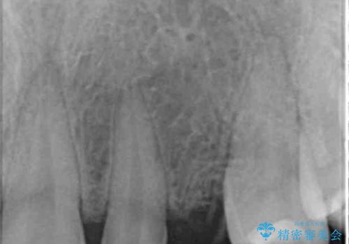 骨造成を伴う 前歯部インプラント治療の治療前